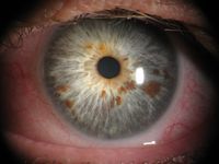 Ein Auge mit blauer Iris und vielen dunkelbraunen Pigmenten