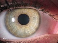 Ein Auge mit einer hellblauen Iris die mehrere Zirkul&auml;rfurchen aufweist