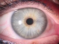 Ein Auge mit einer hellblauen Iris, die sehr feine, straffe Fasern zeigt